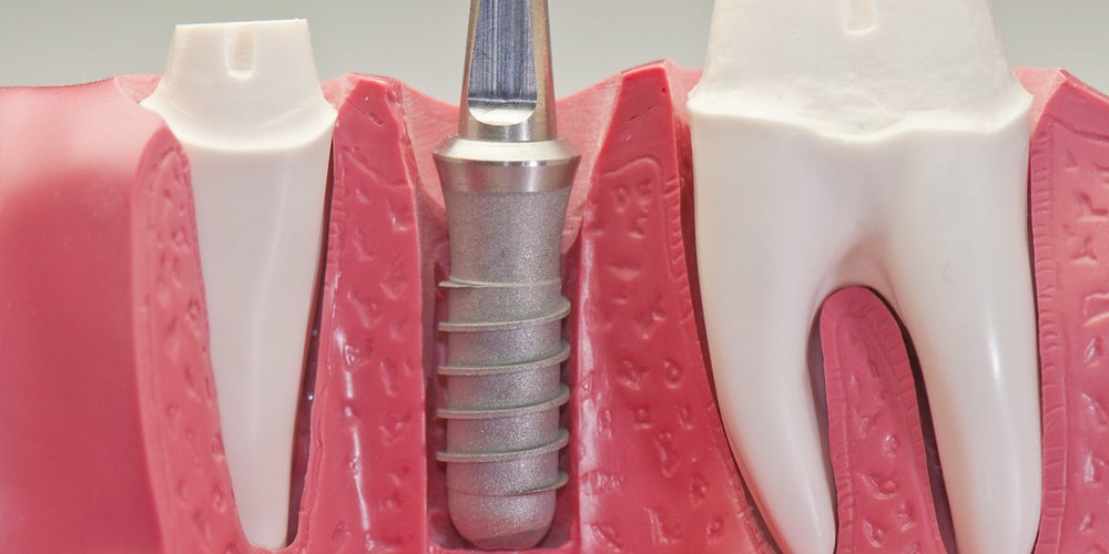 Implants: Step-By-Step Guide From Consultation to Aftercare